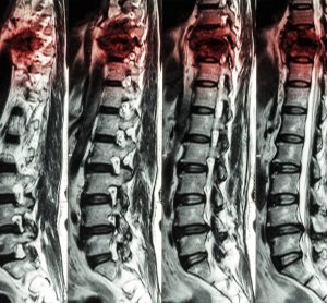 MRI scans showing a spinal cord injury in the thoracic region getting worse with time