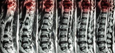 MRI scans showing a spinal cord injury in the thoracic region getting worse with time