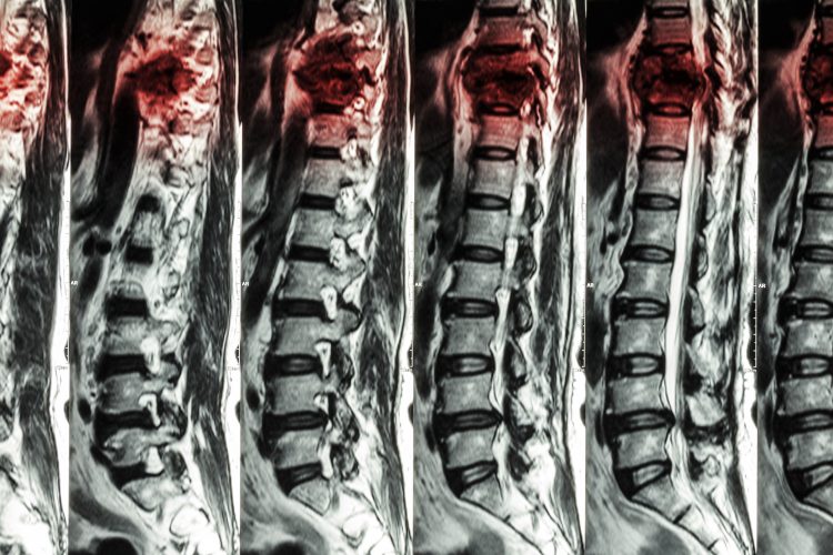 MRI scans showing a spinal cord injury in the thoracic region getting worse with time