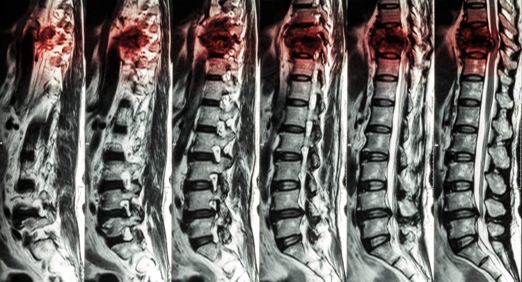 MRI scans showing a spinal cord injury in the thoracic region getting worse with time