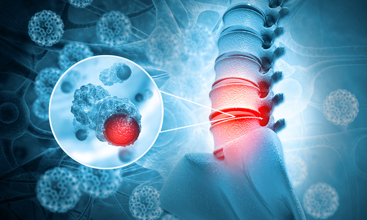 3D illustration of rare spine cancer