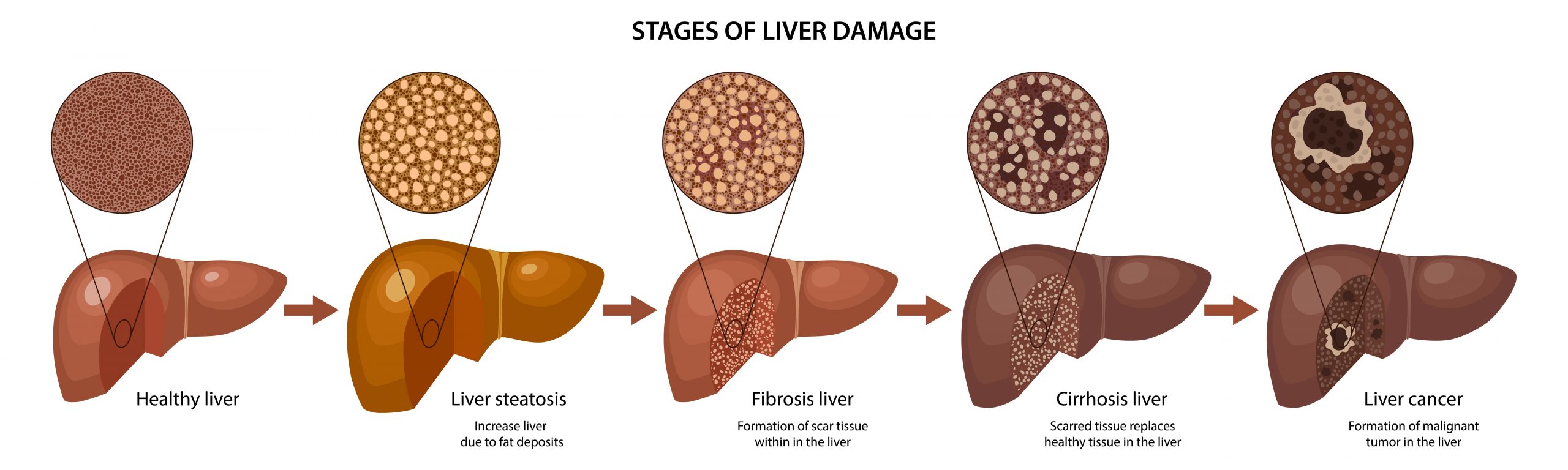 diagram showing the stages of liver disease progression and its impact on tissues. Left to right normal, liver steatosis (fatty liver), liver fibrosis, liver cirrhosis, liver cancer