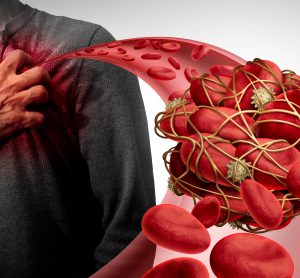 man with hand over heart with cutaway of a blood vessel with a blood clot