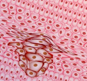 tumour