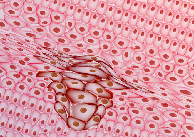 tumour