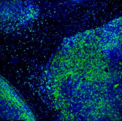 immunoflorescence of t-cells infiltrating a tumour