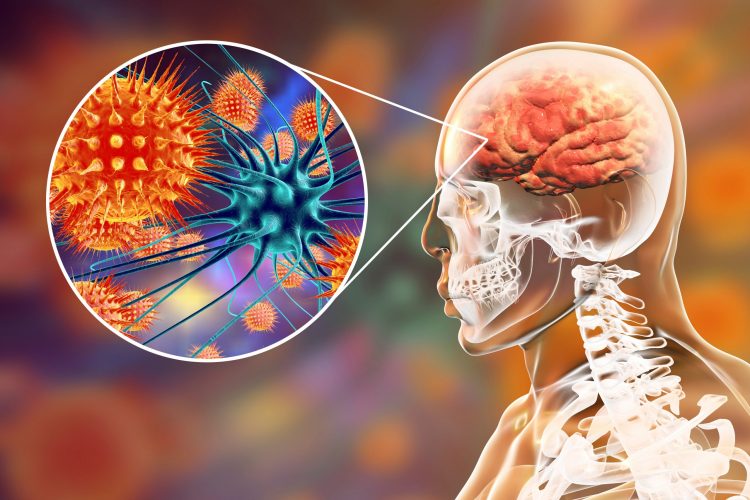 brain with a cutaway of viral particles in orange surrounding a blue neuron - idea of viral encepalopathy