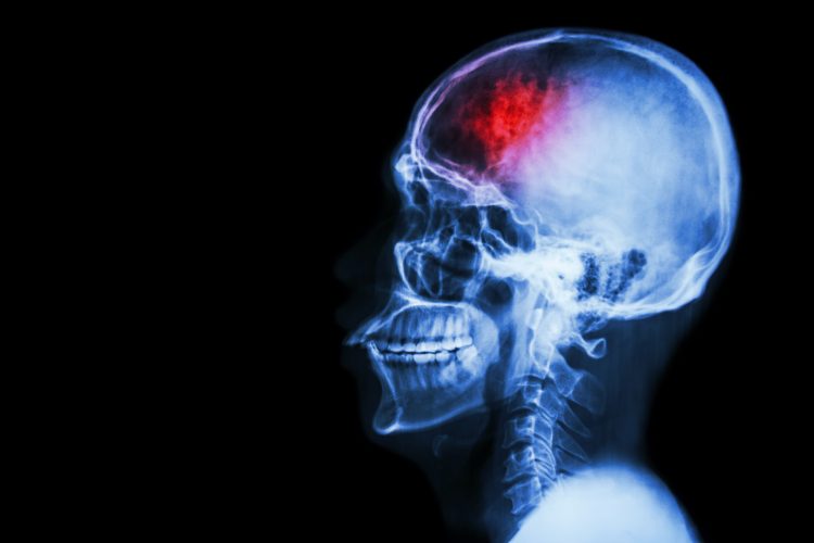 x-ray of human head with a red spot indicating a region of stroke